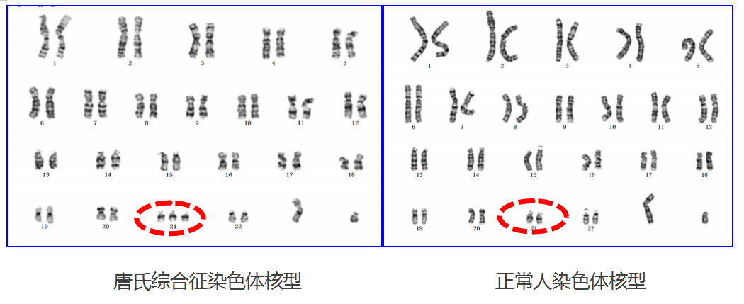 02 唐氏综合征染色体核型唐氏综合征(down syndrome)又称21三体综合征